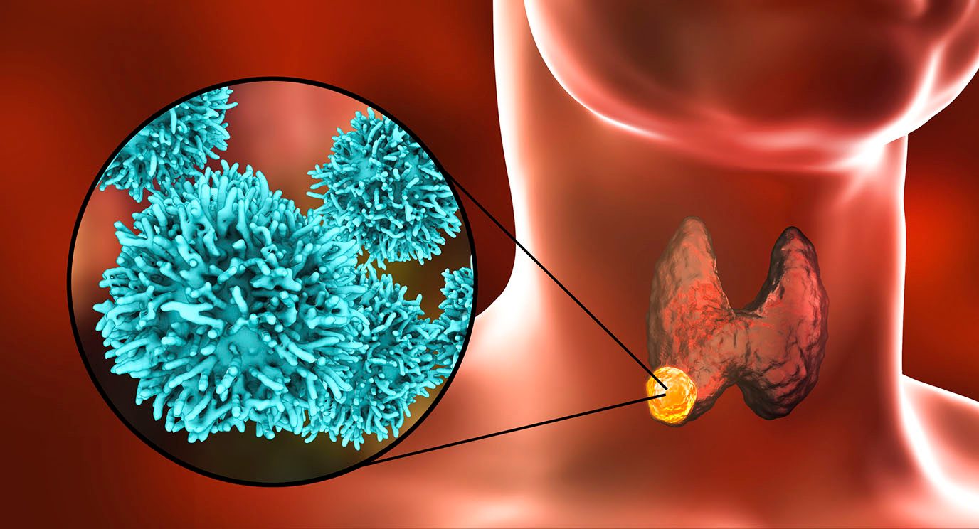 Illustrated image of a thyroid with a close-up of a cancerous cell