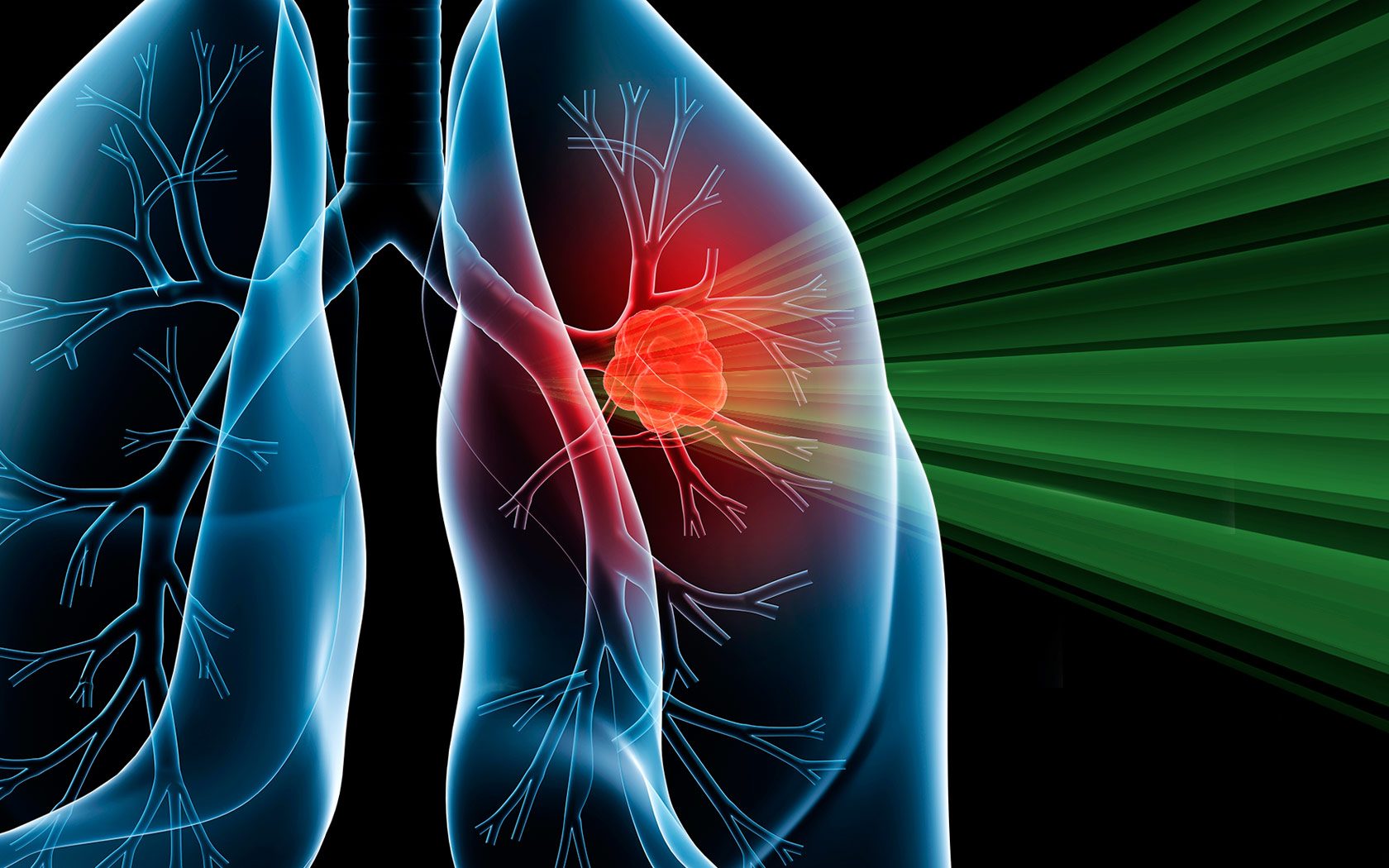 Intensity Modulated Proton Therapy Shows Promise For Lung Cancer 