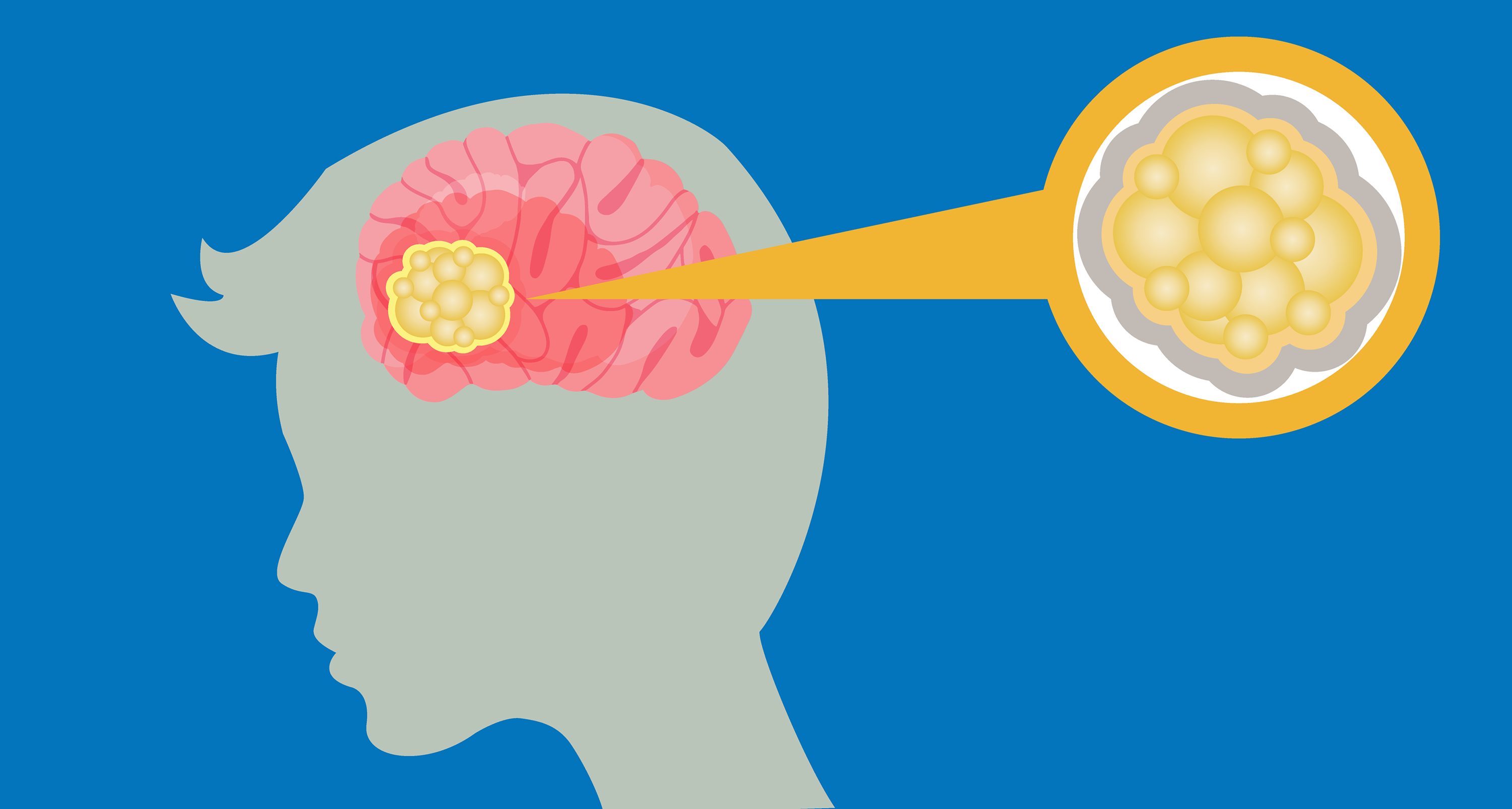 illustration of a human head, highlighting a brain tumor