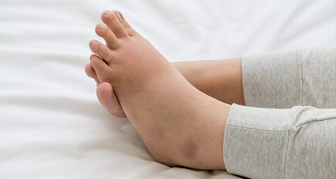 Close-up of two swollen feet in gray leggings on a white bedsheet