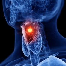 Throat Cancer | MD Anderson Cancer Center