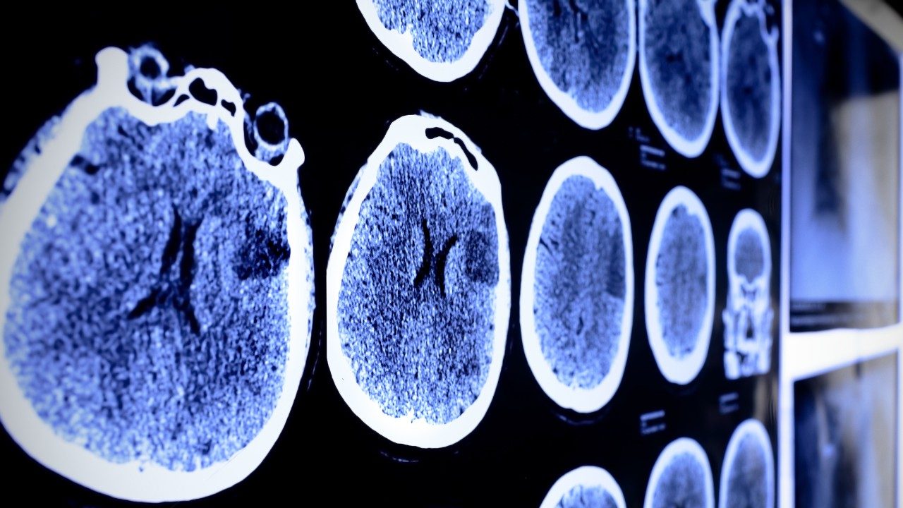 Cancerwise blog post: What to know about brain tumors, brain tumor treatment and clinical trials for brain tumors