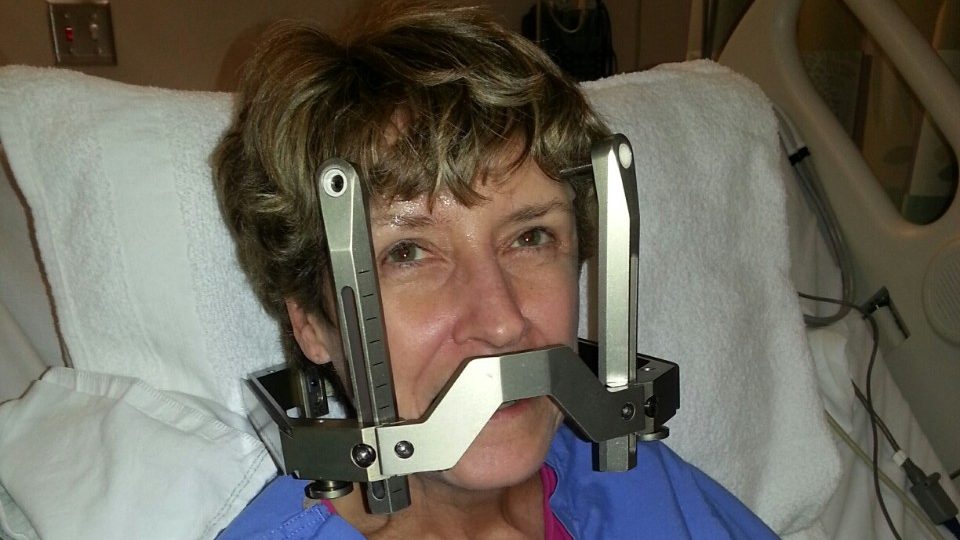 Cancerwise blog post: Lung cancer survivor recalls her Gamma Knife surgery