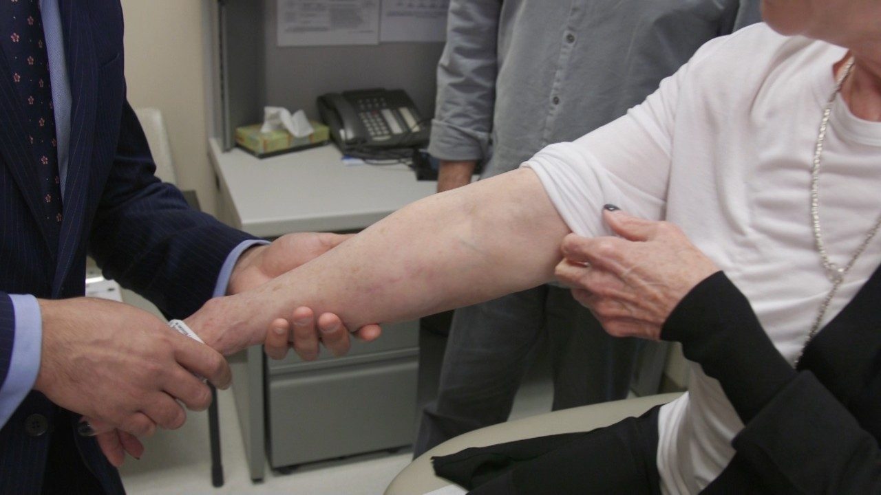 Arm being examined for lymphedema, a common cancer treatment side effect