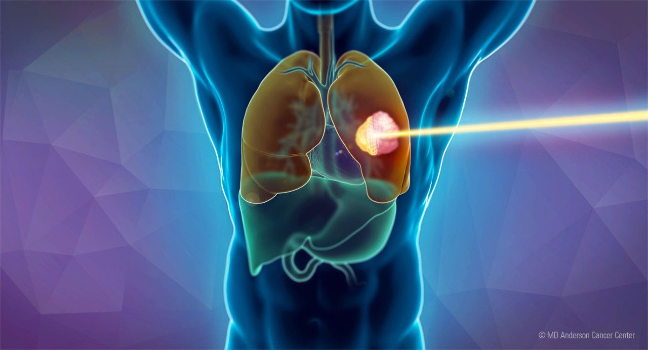 Illustration of proton therapy beam targeting lung cancer