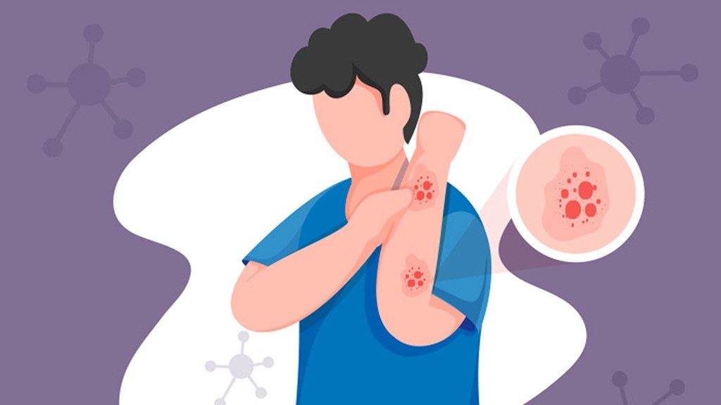 Illustration with purple background and man scratching red rash on wrist