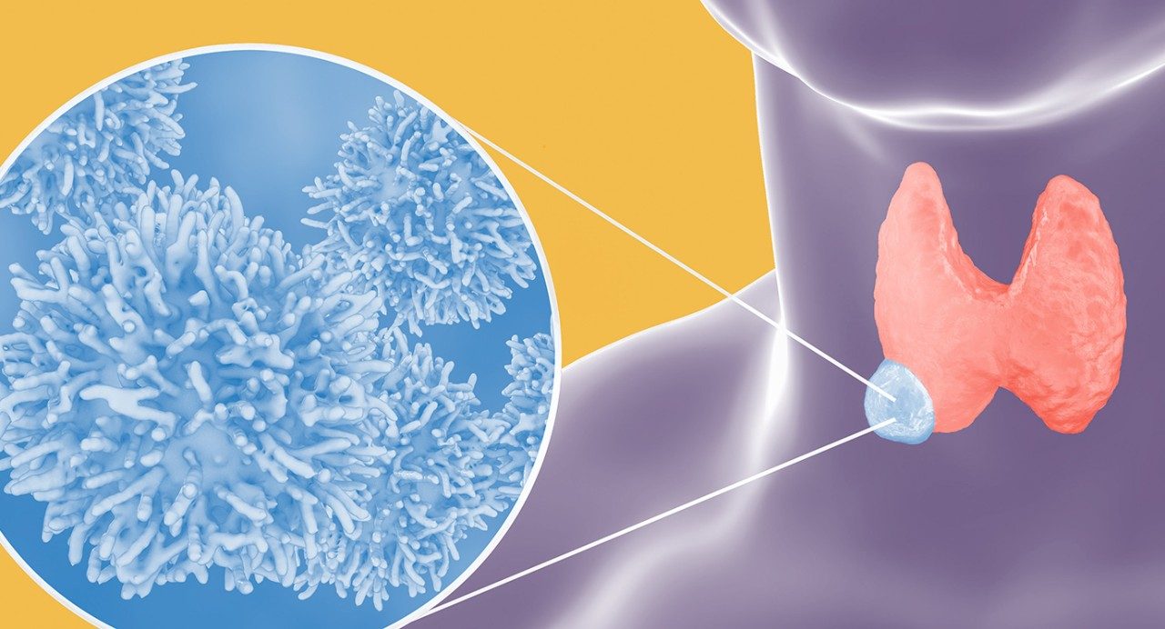 Illustration of a lump on the thyroid gland, which can be an early sign of cancer.