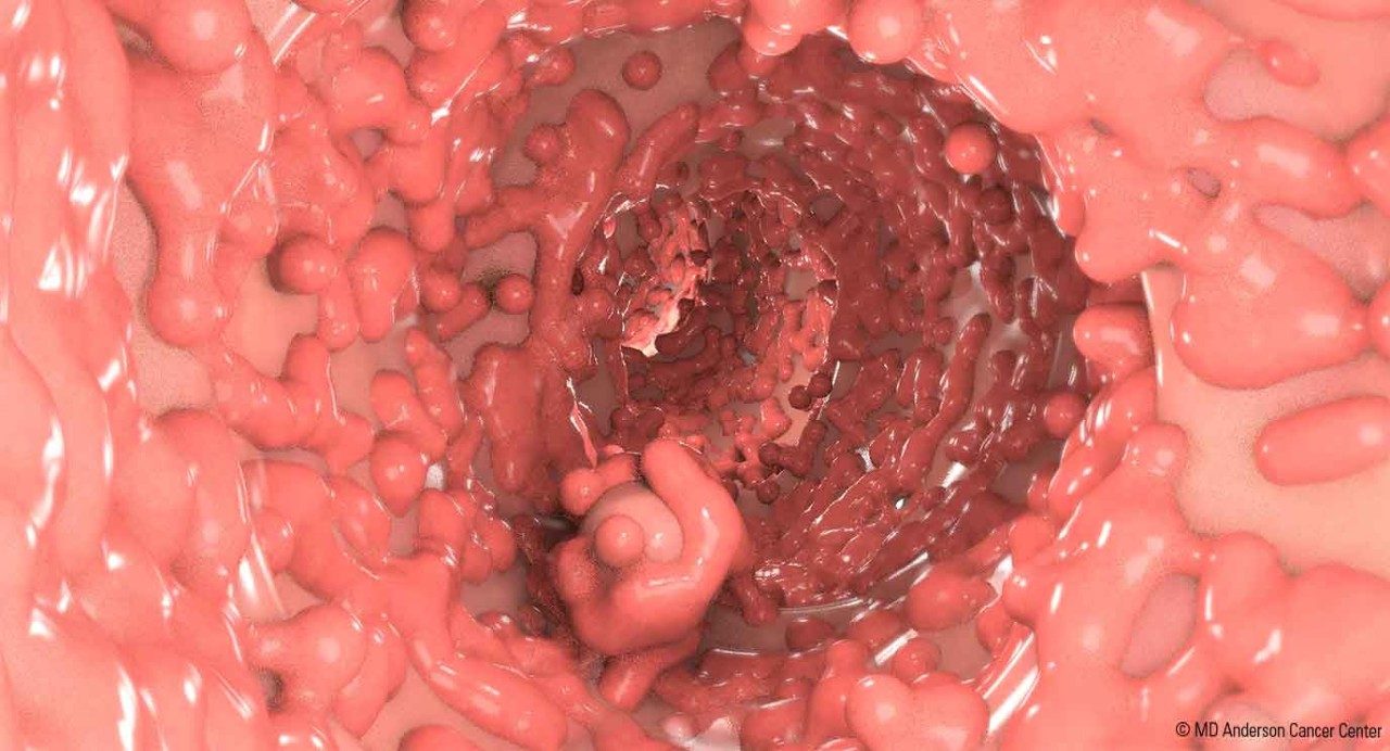 Illustration of a colon covered with hundreds of polyps