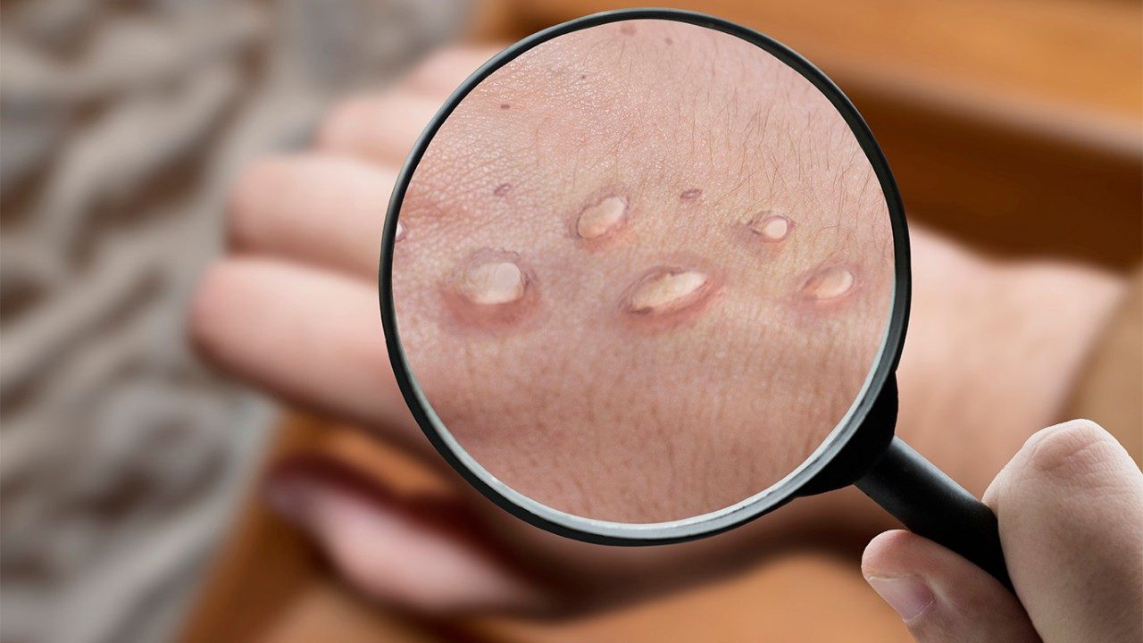 View through a magnifying glass of monkeypox pustules on a human hand