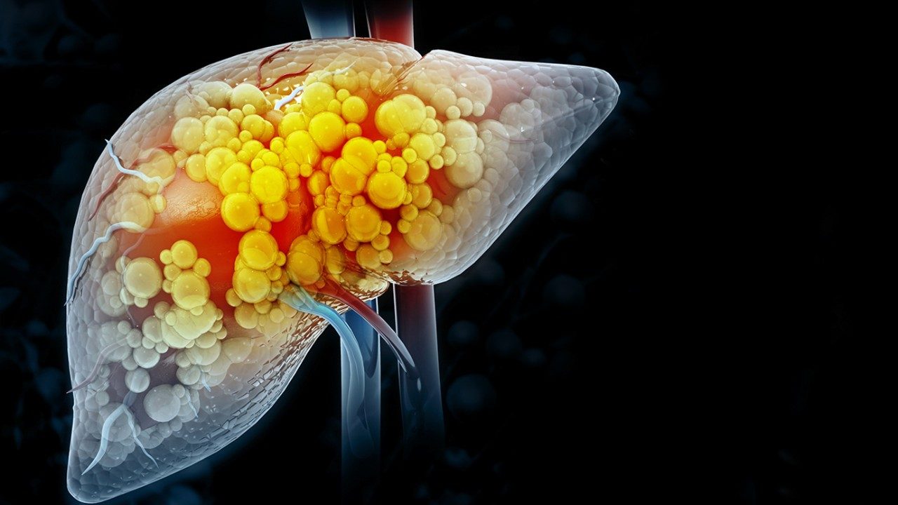 illustration of a hepatocellular carcinoma