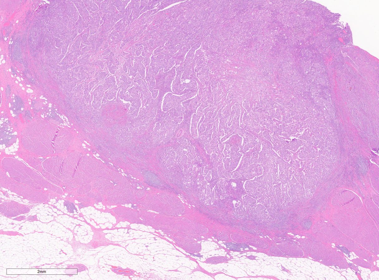 High-grade urothelial carcinoma