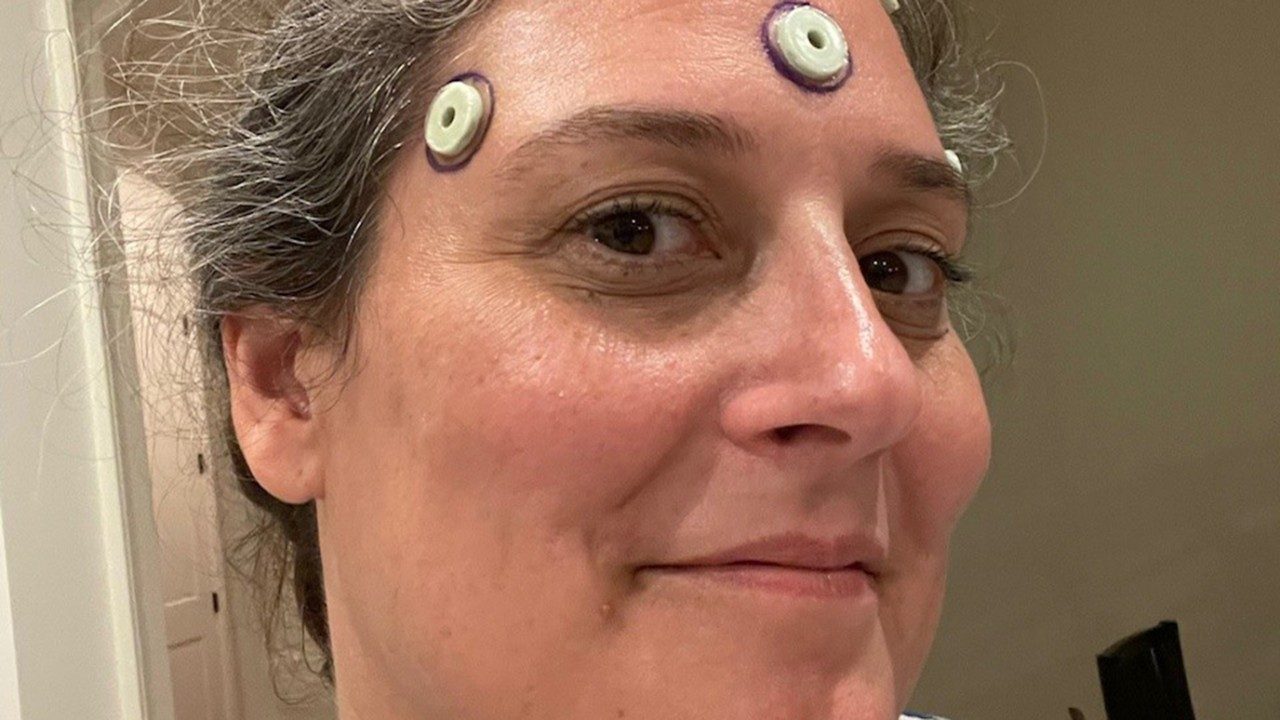 Acoustic neuroma survivor Nikki Lacobie wears markers used for image guidance during her surgery.