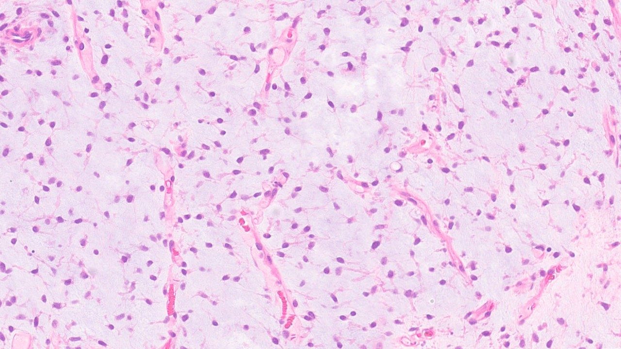 Pictomicrograph of myxoid liposarcoma