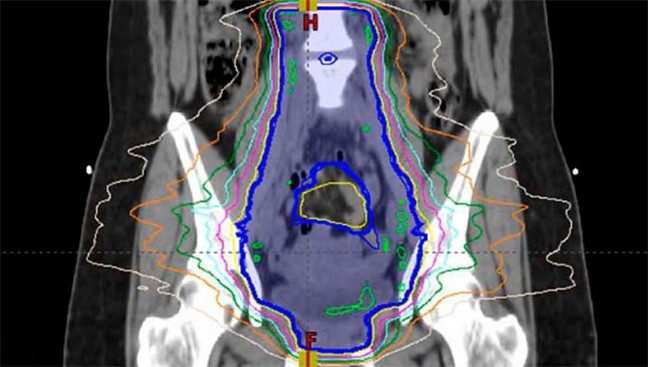 Screening image of a pelvis marked up using the Radiation Planning Assistant tool