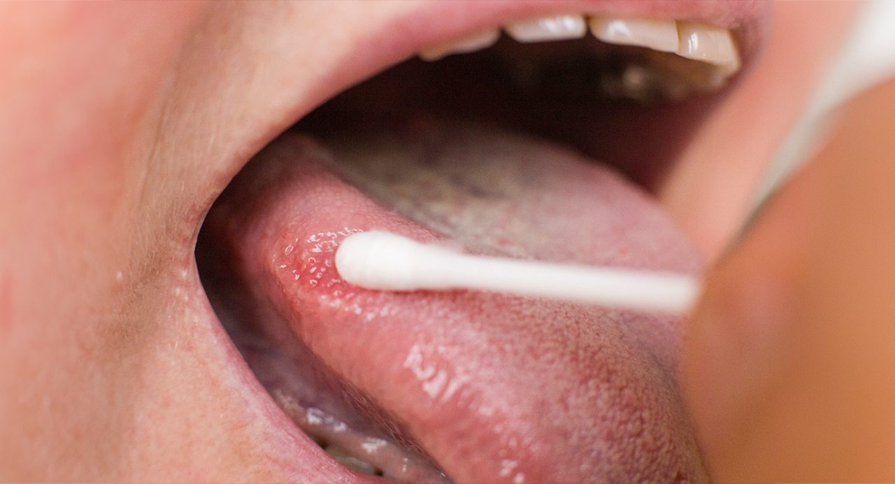 Close-up of tongue being swabbed with a Q-tip