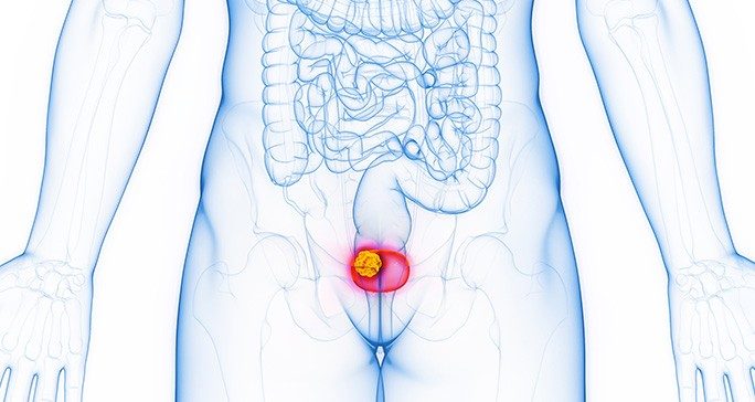 Tumor in the bladder