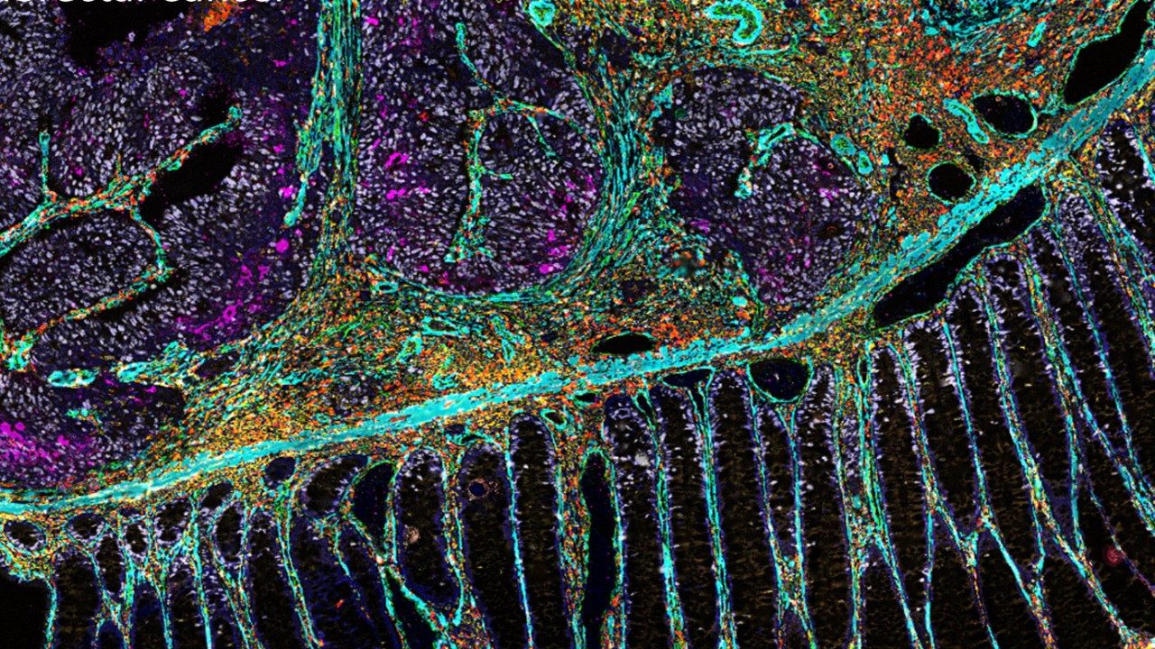 Multiplex image highlighting various cell types in a tissue sample of colorectal cancer. Image courtesy of the Immunotherapy Platform.