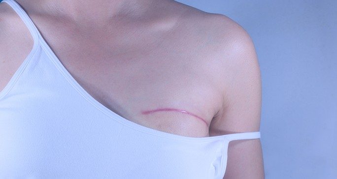 Close-up of healed mastectomy scar above left breast of woman wearing white tank top