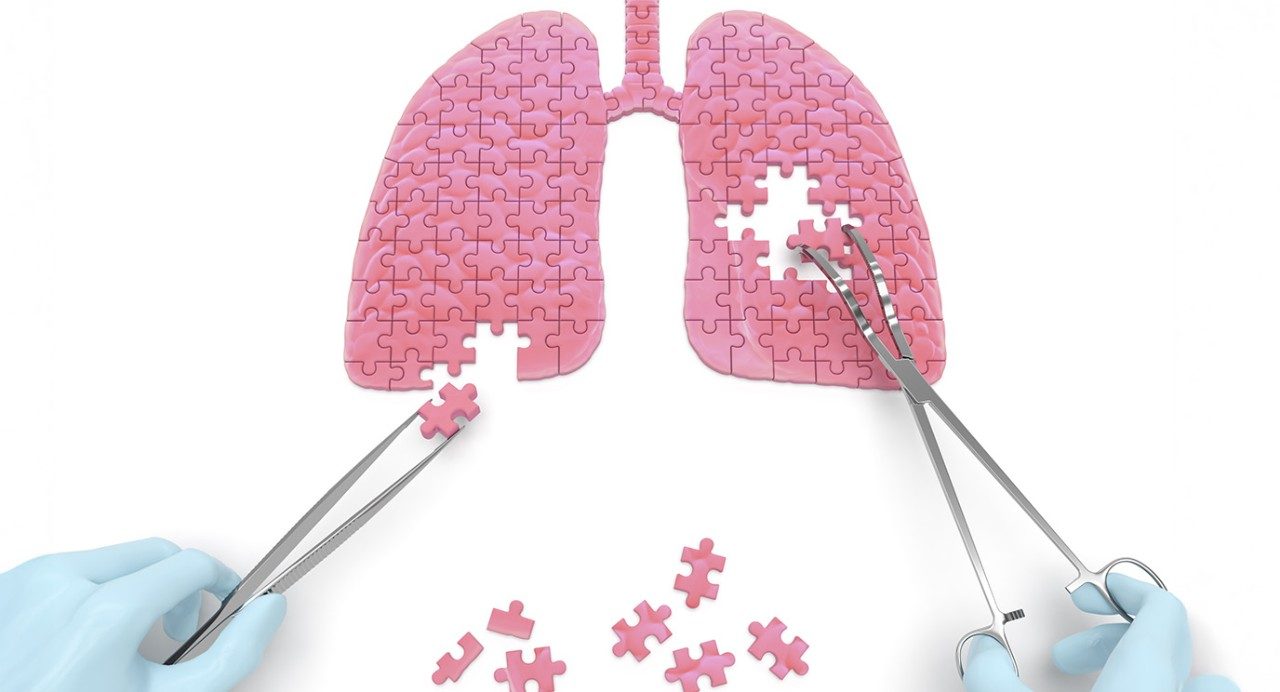 Pink lung-shaped jigsaw puzzle being taken apart by gloved hands holding forceps