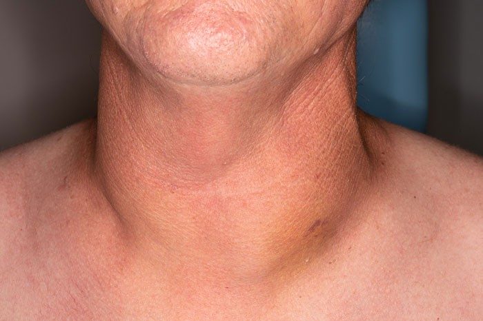 A photograph of a neck taken from the front. There is mild swelling on the left side of the patient's neck.