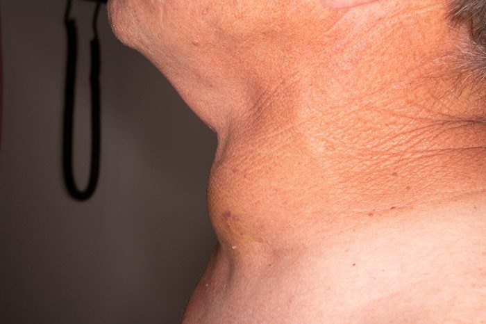 A photograph of a swollen neck taken from the side.