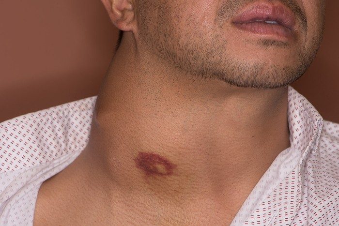 A photo of a neck taken from the front. The right side of the patient's neck is very swollen and there is a bruise on the swollen area.