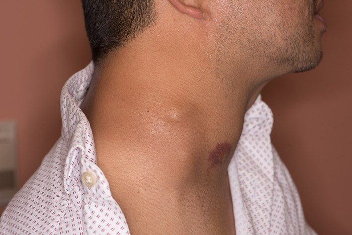 A photograph of a neck taken from the side. There is a distinct mass in the center of the neck.