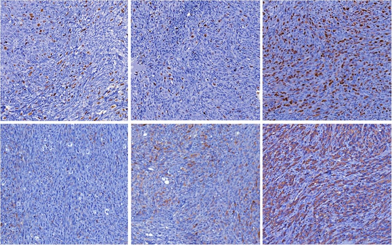 pancreatic cancer