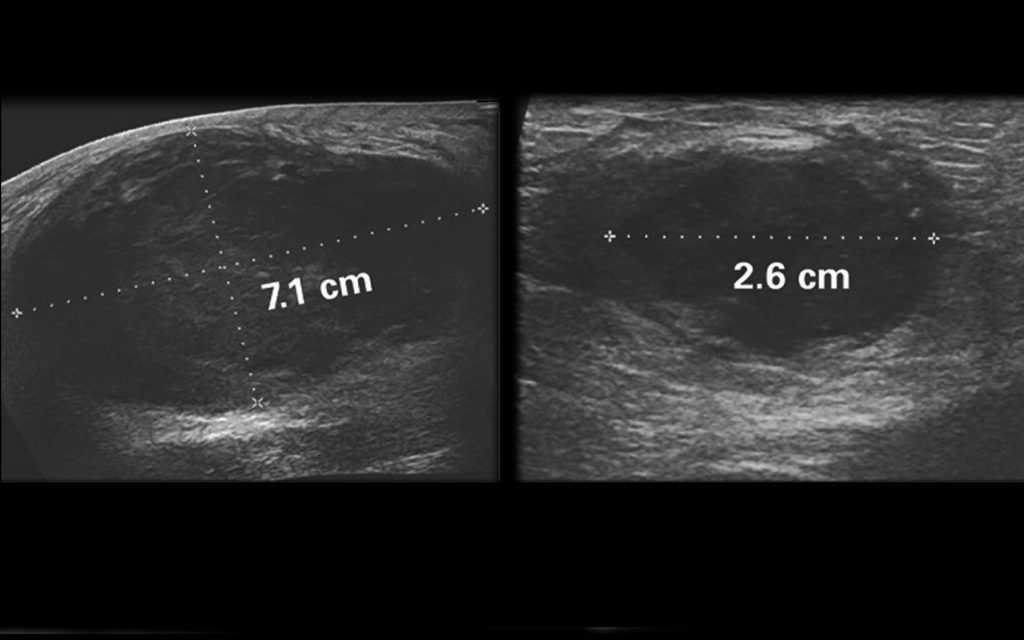 triple negative breast cancer