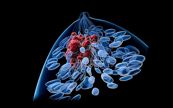 breast cancer contralateral breast cancer