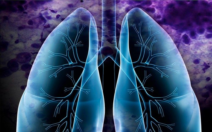 lung with biopsy