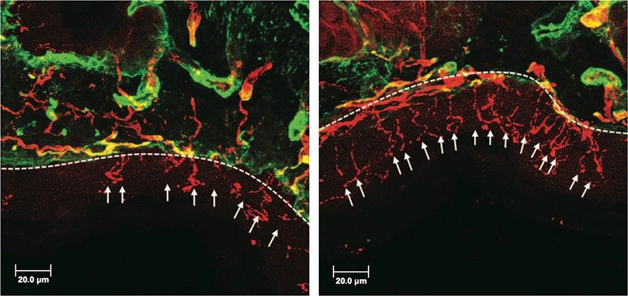 Photomicrographs of biopsy specimens from the paws of mice with cisplatin-induced neuropathy treated with control vehicle (left) or the HDAC6 inhibitor ACY-1083 (right) show that ACY-1083 reversed intraepidermal nerve fiber (IENF) loss, an early indicator of axonal pathology.