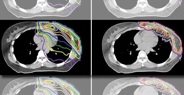 A breast cancer patient’s post-mastectomy radiation treatment plans show a mean dose to the heart of 3.63 Gy with photon-based therapy (left) but only 0.05 Gy with proton therapy (right). Images courtesy of Rebecca Howell, M.D.