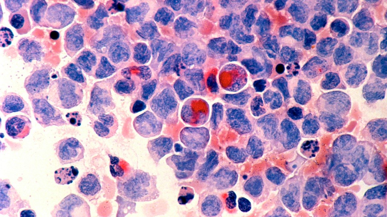 acute myeloid leukemia cells