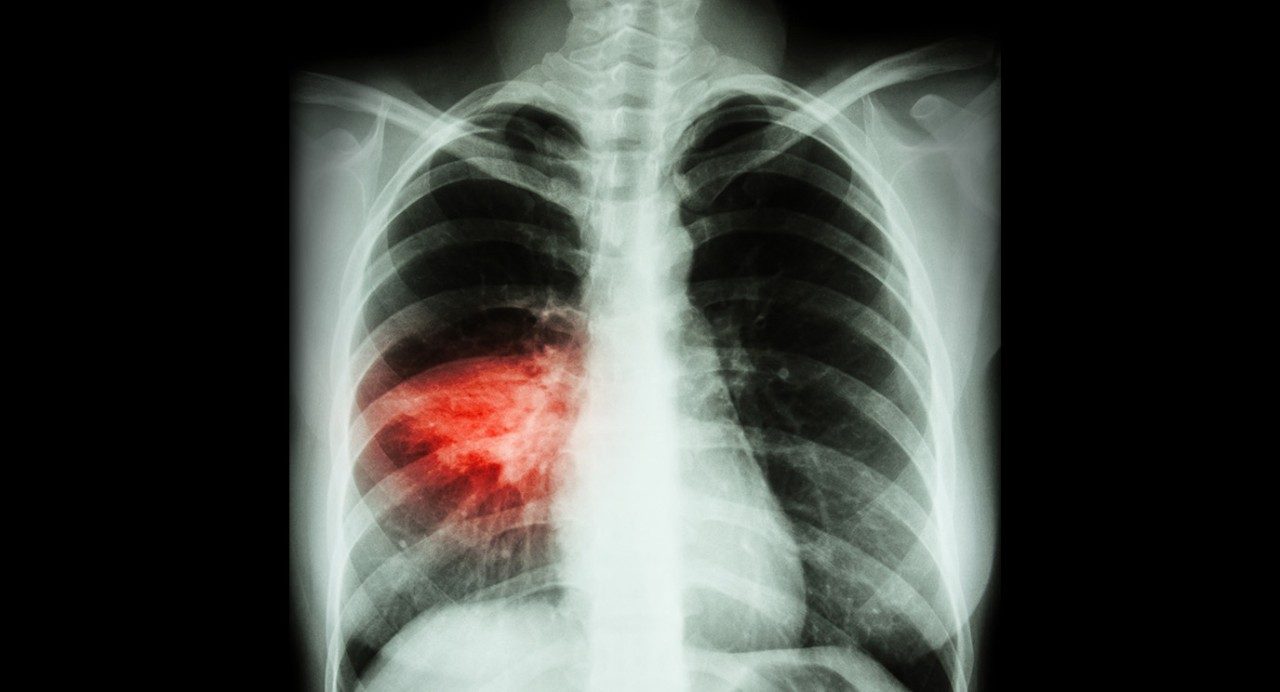 Pneumonia in the lungs