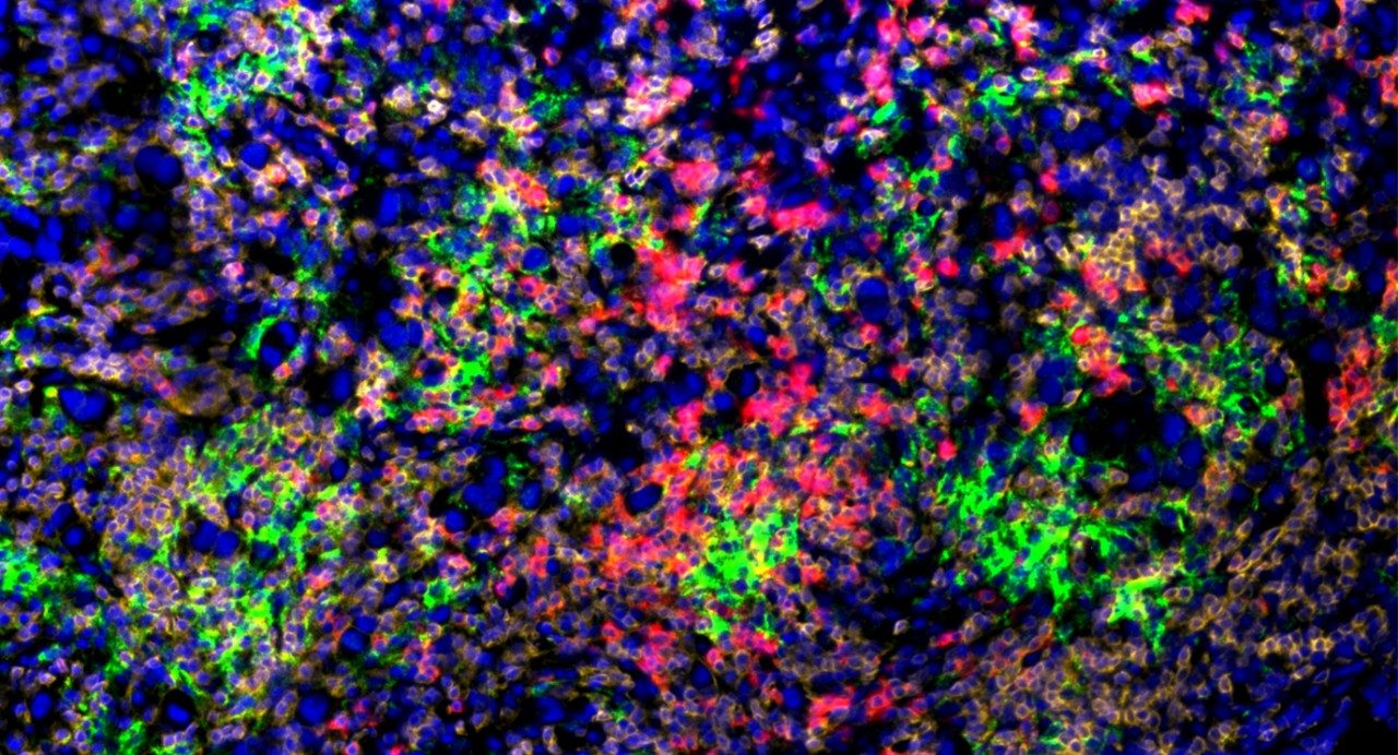 CD8-positive immune system T cells attacking cancer cells.