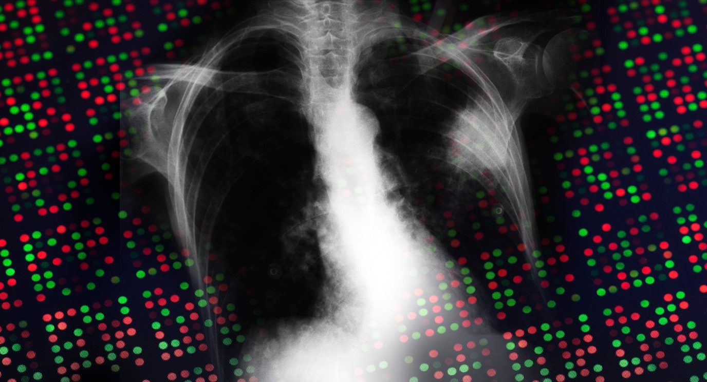 Multi-region whole-exome sequencing of precancerous growths and tumors points to genomic evolution from benign growths to lung cancer. 