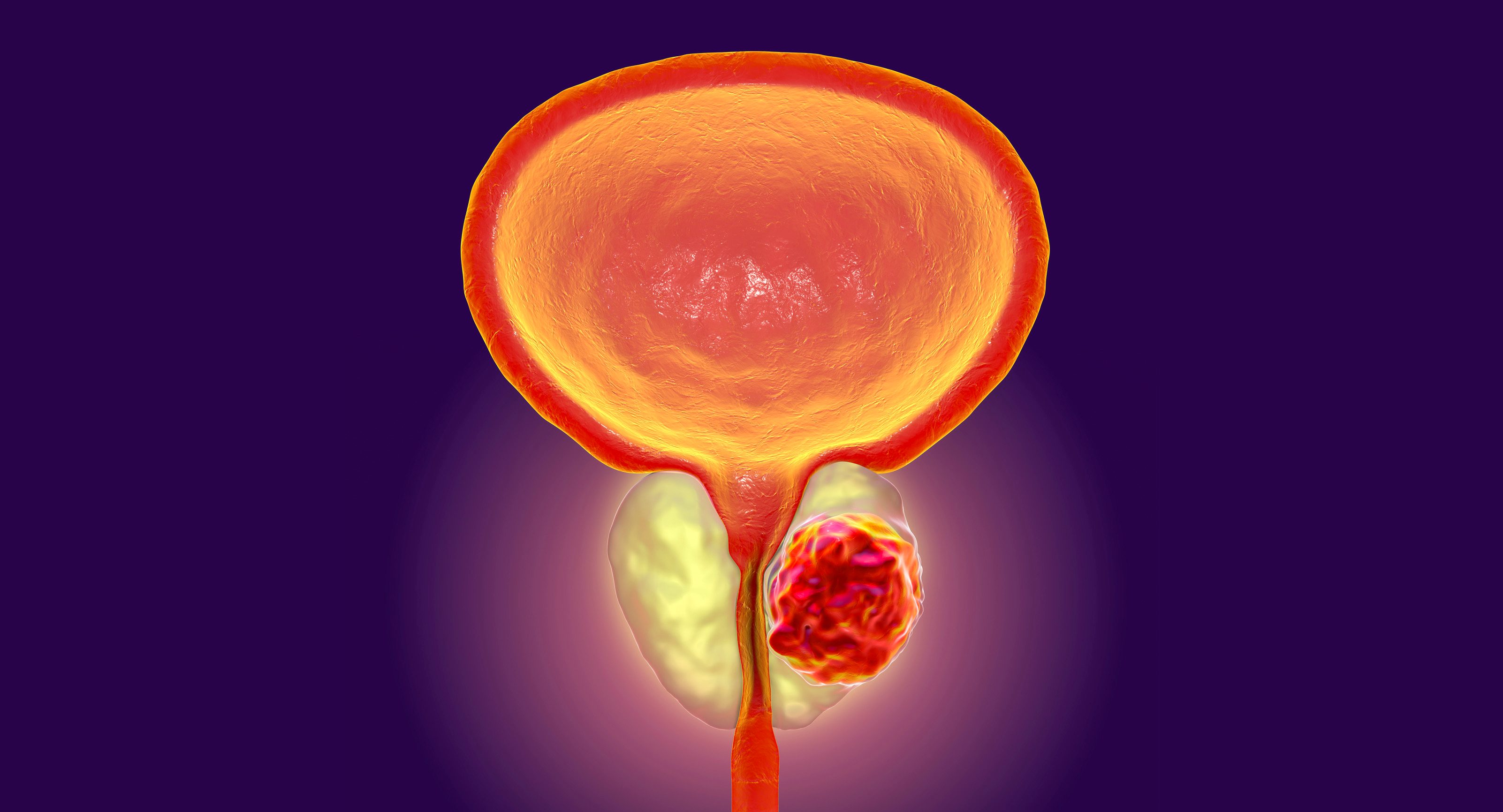 Patients with localized prostate cancer who underwent prostatectomy experienced worse urinary incontinence than those who received other treatment options.