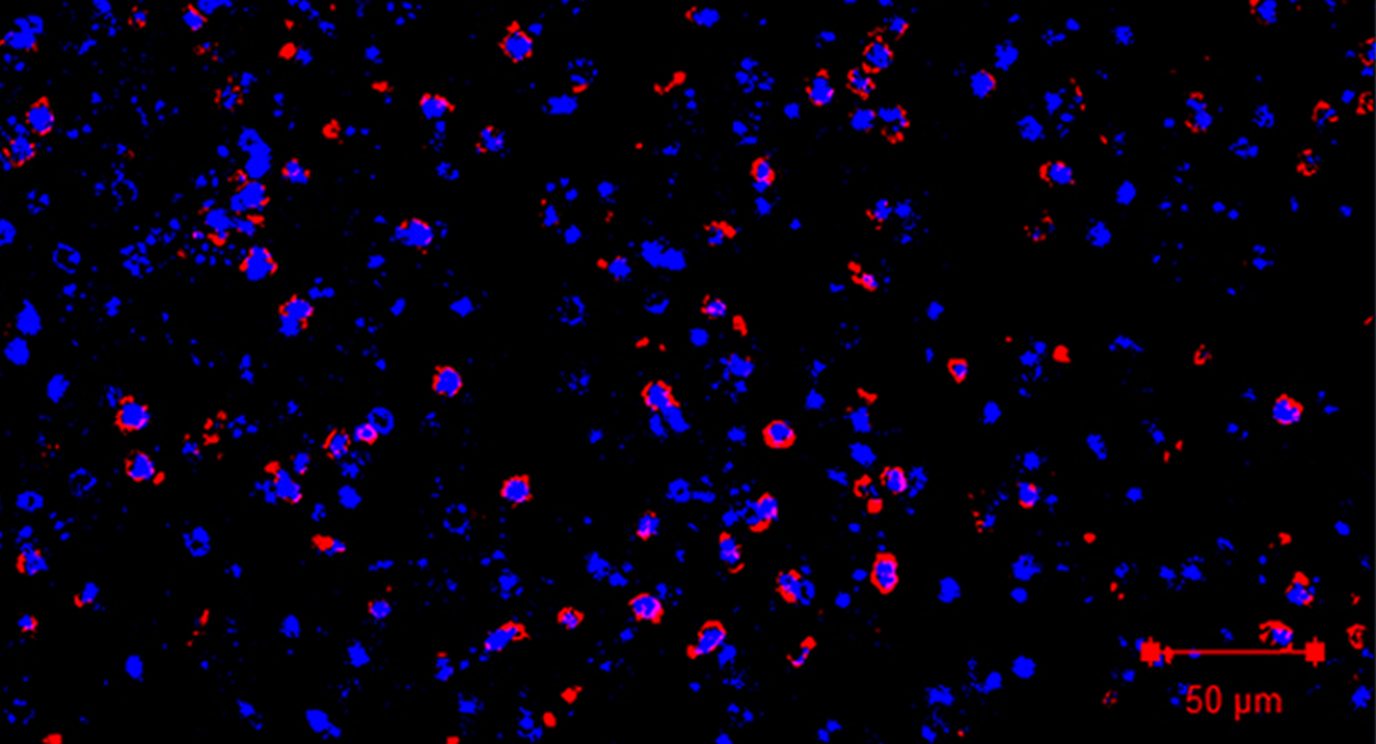 Immunofluorescence showing infiltration of immunosuppressive neutrophils into brain metastases. 