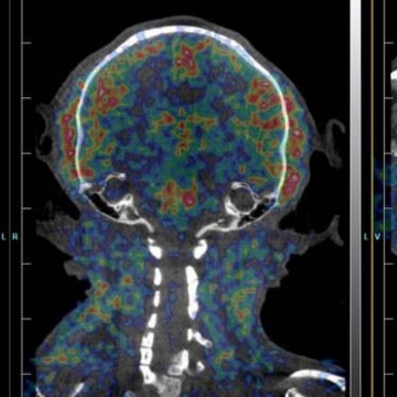 Diffuse Large B-cell Lymphoma | MD Anderson Cancer Center