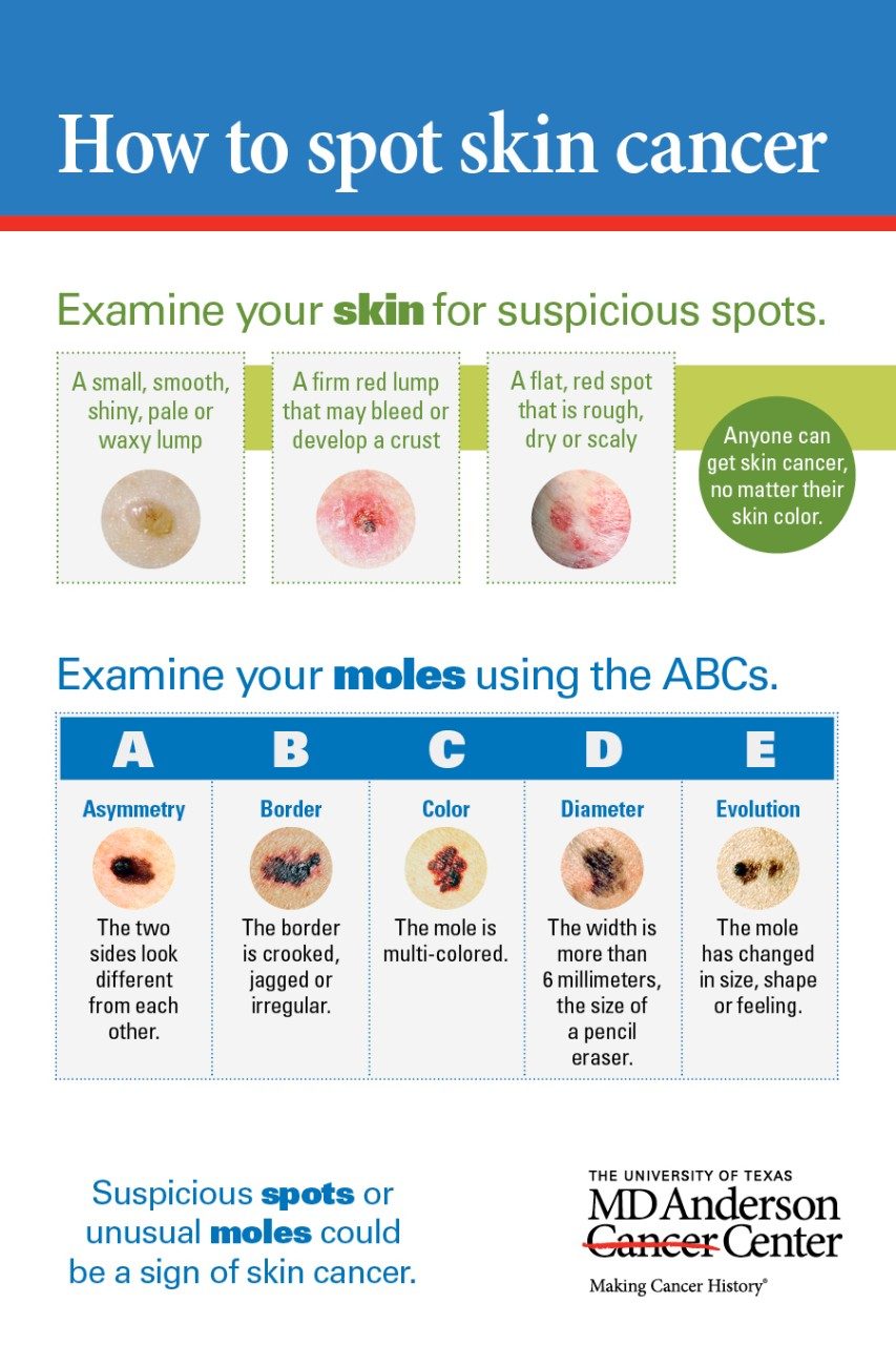 Skin cancer: Uncover that mole | MD Anderson Cancer Center