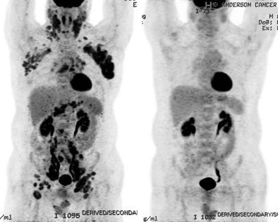 Adelantos en el tratamiento quirúrgico del linfedema MD