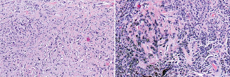 Una muestra de biopsia