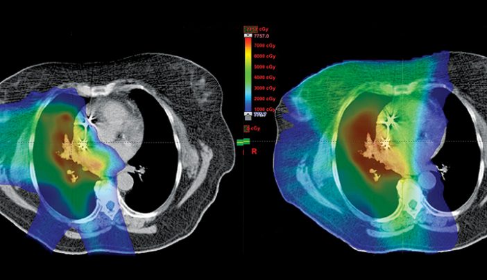 Exploring Proton Therapys Effectiveness On The Most Common Form Of